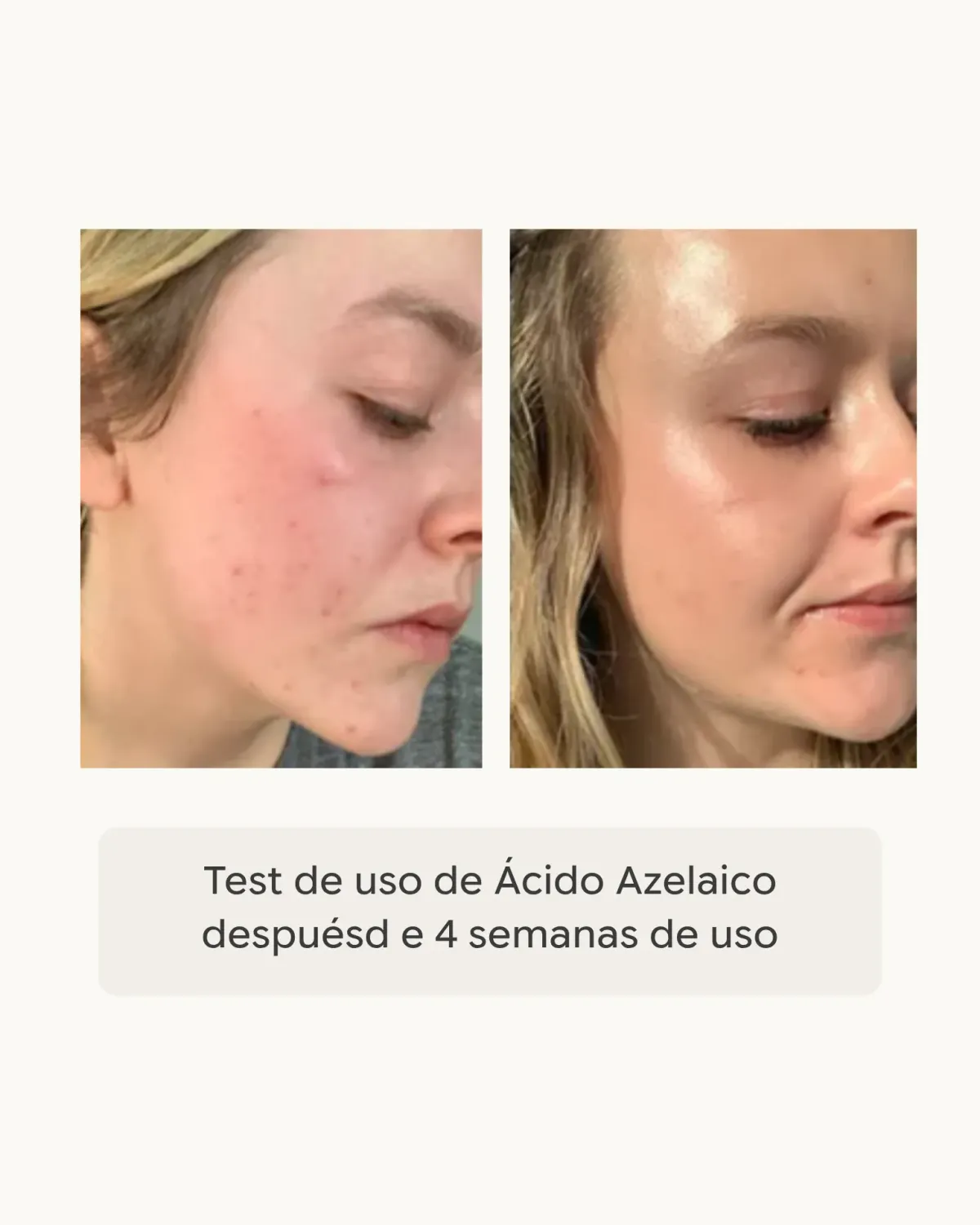 Dhyvana Clear Skin Azelaic Serum Azelainsäure unreine Haut