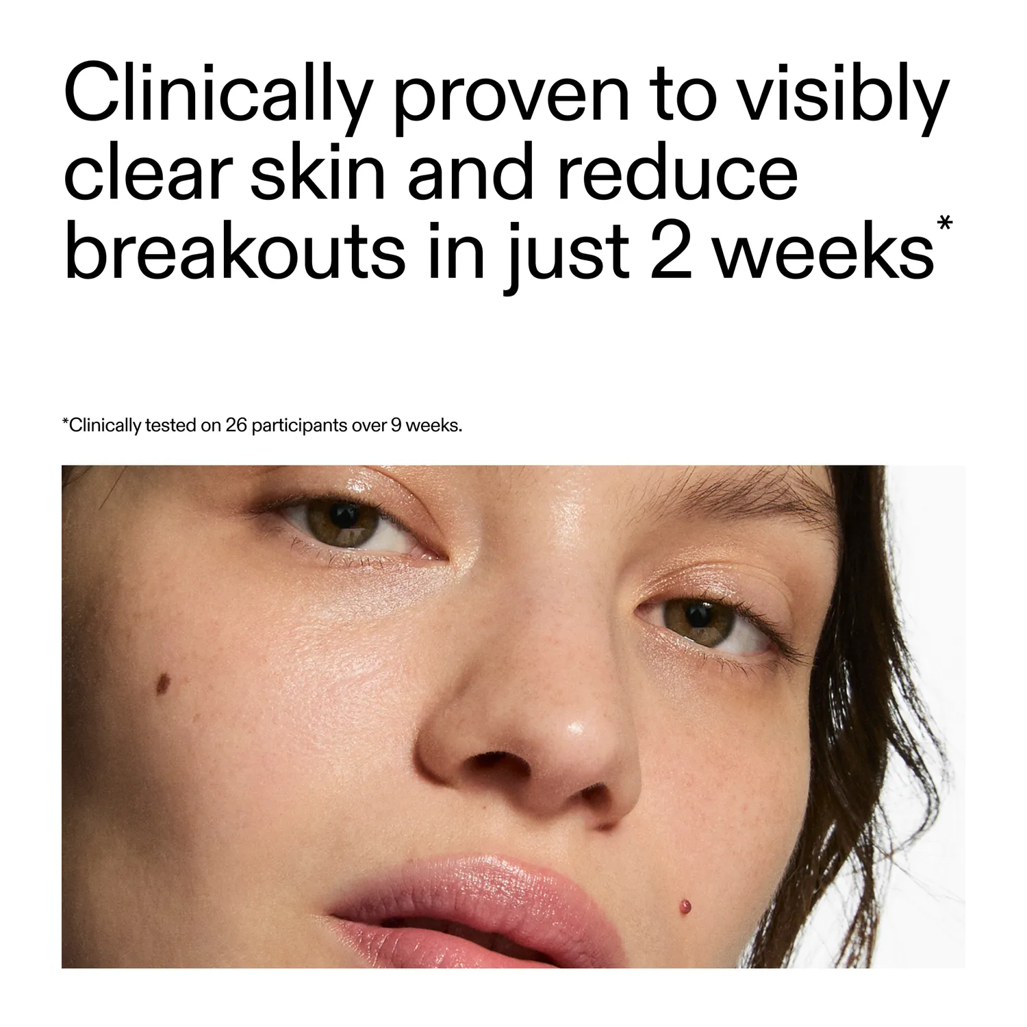 The INKEY List 360° Acne Clearing Duo Serum gegen Pickel