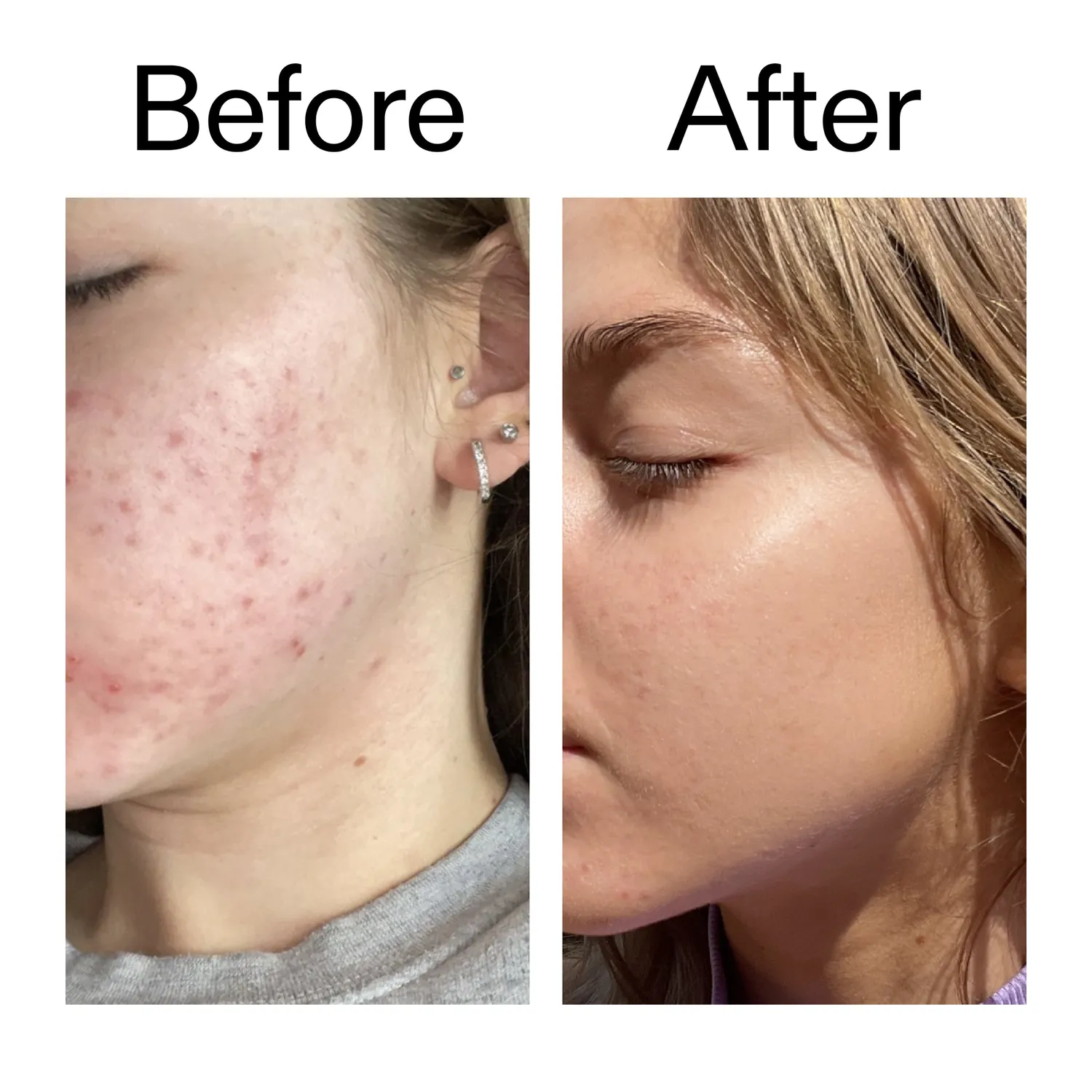 The INKEY List BHA Serum 30ml mit 2% Salicylsäure für ölige Haut