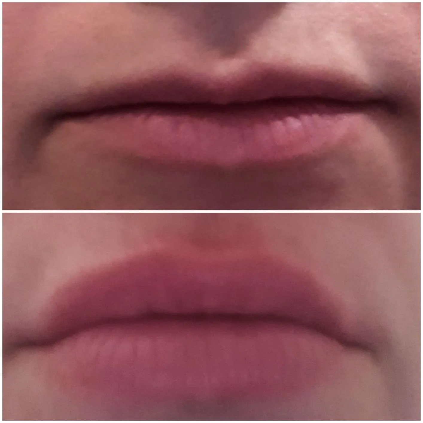 Beautylines HyaLips Boost System Lippenbooster Hyaluron Roller