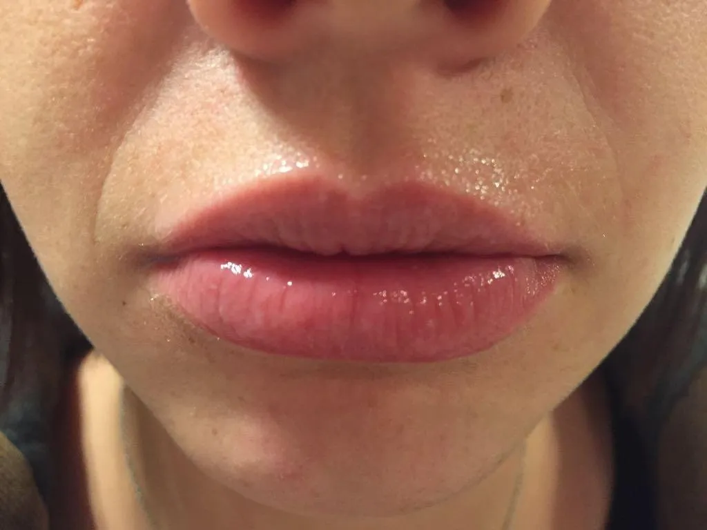 Beautylines HyaLips Boost System Lippenbooster Hyaluron Roller