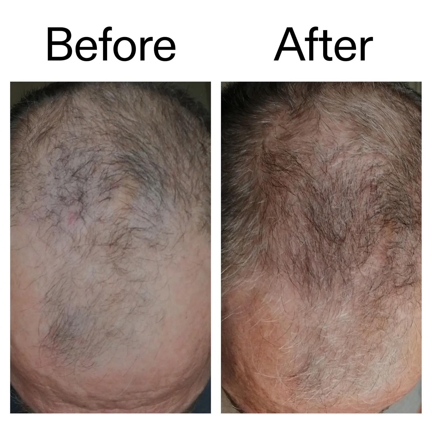 The INKEY List 3 Month Hair Growth Trio Serum 3x150ml